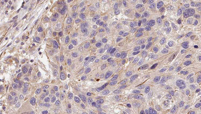 GAS6 Antibody - 1:100 staining human Melanoma tissue by IHC-P. The sample was formaldehyde fixed and a heat mediated antigen retrieval step in citrate buffer was performed. The sample was then blocked and incubated with the antibody for 1.5 hours at 22°C. An HRP conjugated goat anti-rabbit antibody was used as the secondary.
