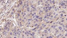 GAS6 Antibody - 1:100 staining human Melanoma tissue by IHC-P. The sample was formaldehyde fixed and a heat mediated antigen retrieval step in citrate buffer was performed. The sample was then blocked and incubated with the antibody for 1.5 hours at 22°C. An HRP conjugated goat anti-rabbit antibody was used as the secondary.