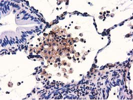 GAS7 Antibody - IHC of paraffin-embedded Carcinoma of Human lung tissue using anti-GAS7 mouse monoclonal antibody.