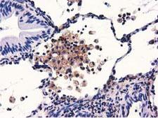 GAS7 Antibody - IHC of paraffin-embedded Carcinoma of Human lung tissue using anti-GAS7 mouse monoclonal antibody.