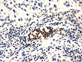 GAS7 Antibody - IHC of paraffin-embedded Carcinoma of Human bladder tissue using anti-GAS7 mouse monoclonal antibody.