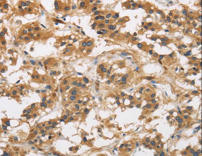GAS7 Antibody - Immunohistochemistry of paraffin-embedded Human thyroid cancer using GAS7 Polyclonal Antibody at dilution of 1:50.