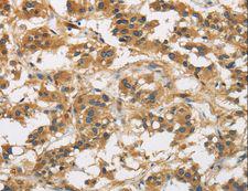 GAS7 Antibody - Immunohistochemistry of paraffin-embedded Human thyroid cancer using GAS7 Polyclonal Antibody at dilution of 1:50.