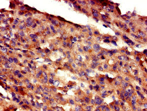 GAS7 Antibody - Immunohistochemistry of paraffin-embedded human melanoma cancer at dilution of 1:100