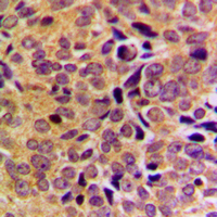 GAS8 Antibody - Immunohistochemical analysis of GAS8 staining in human breast cancer formalin fixed paraffin embedded tissue section. The section was pre-treated using heat mediated antigen retrieval with sodium citrate buffer (pH 6.0). The section was then incubated with the antibody at room temperature and detected using an HRP conjugated compact polymer system. DAB was used as the chromogen. The section was then counterstained with hematoxylin and mounted with DPX.