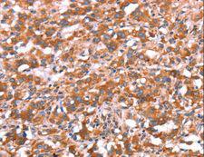 GAS8 Antibody - Immunohistochemistry of paraffin-embedded Human gastric cancer using GAS8 Polyclonal Antibody at dilution of 1:30.