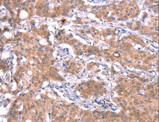 GAS8 Antibody - Immunohistochemistry of paraffin-embedded Human gastric cancer using GAS8 Polyclonal Antibody at dilution of 1:30.