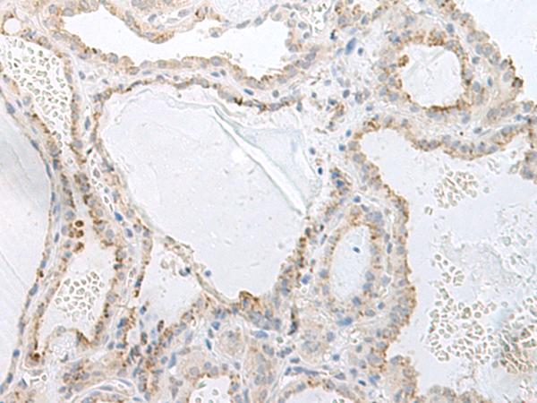GASP2 / GPRASP2 Antibody - Immunohistochemistry of paraffin-embedded Human thyroid cancer tissue  using GPRASP2 Polyclonal Antibody at dilution of 1:75(×200)
