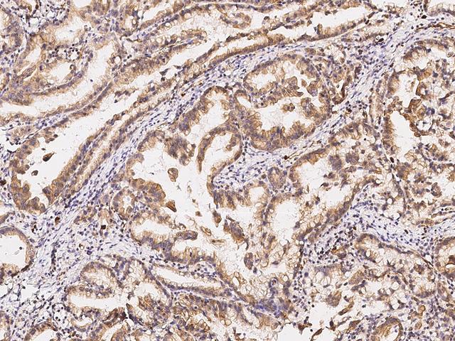 GASP2 / GPRASP2 Antibody - Immunochemical staining of human GPRASP2 in human gastric cancer with rabbit polyclonal antibody at 1:300 dilution, formalin-fixed paraffin embedded sections.