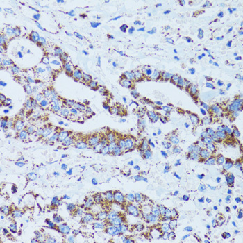 Gastric Inhibitory Peptide Antibody - Immunohistochemistry of paraffin-embedded human colon carcinoma tissue.