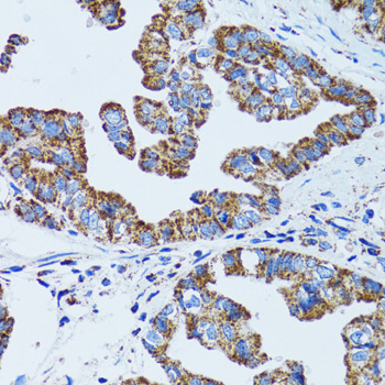 Gastric Inhibitory Peptide Antibody - Immunohistochemistry of paraffin-embedded human gastric cancer tissue.