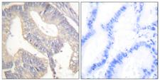 Gastrin Antibody - Immunohistochemistry analysis of paraffin-embedded human colon carcinoma tissue, using Gastrin Antibody. The picture on the right is blocked with the synthesized peptide.