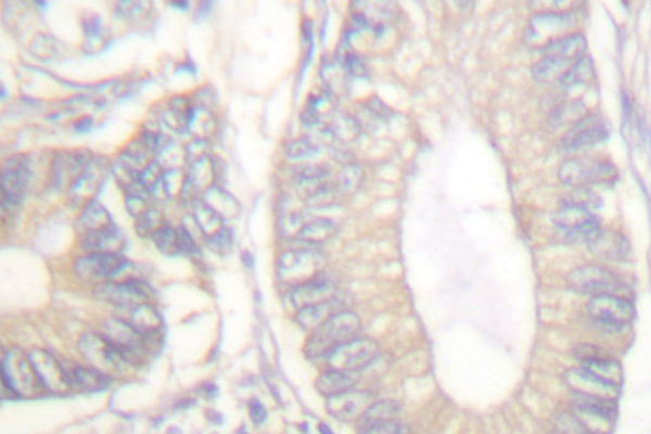 Gastrin Antibody - IHC of Gastrin (M90) pAb in paraffin-embedded human colon carcinoma tissue.