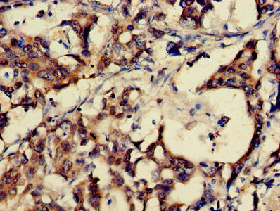 Gastrin Releasing Peptide Antibody - Immunohistochemistry of paraffin-embedded human gastric cancer using GRP Antibody at dilution of 1:100