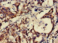 Gastrin Releasing Peptide Antibody - Immunohistochemistry of paraffin-embedded human gastric cancer using GRP Antibody at dilution of 1:100
