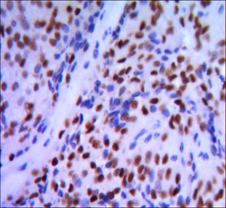 GATA1 Antibody - IHC of paraffin-embedded pancreatic cancer, using GATA1 mouse monoclonal antibody with DAB staining.