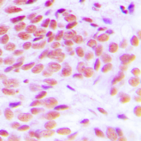 GATA1 Antibody - Immunohistochemical analysis of GATA1 staining in human breast cancer formalin fixed paraffin embedded tissue section. The section was pre-treated using heat mediated antigen retrieval with sodium citrate buffer (pH 6.0). The section was then incubated with the antibody at room temperature and detected using an HRP conjugated compact polymer system. DAB was used as the chromogen. The section was then counterstained with hematoxylin and mounted with DPX.