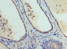 GATA1 Antibody - Immunohistochemistry of paraffin-embedded human prostate cancer at dilution 1:100