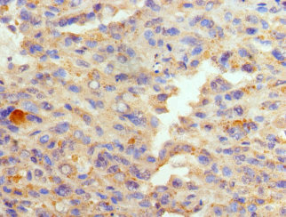 GATA1 Antibody - Paraffin-embedding Immunohistochemistry using human melanoma cancer at dilution 1:100