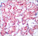 GATA1 Antibody - Detection of GATA1 (phospho-Ser142) in paraffin-embedded human breast carcinoma tissue.
