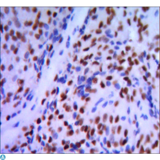 GATA1 Antibody - Immunohistochemistry (IHC) analysis of paraffin-embedded pancreatic cancer, with DAB staining using GATA-1 Monoclonal Antibody.