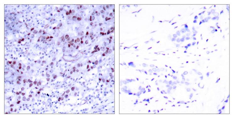 GATA1 Antibody - Peptide - + Immunohistochemical analysis of paraffin-embedded human breast carcinoma tissue using GATA-1 (Ab-142) antibody.