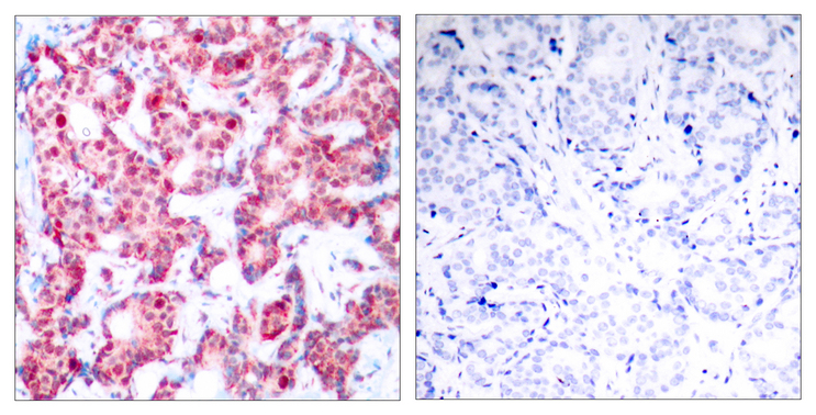 GATA1 Antibody - Immunohistochemistry analysis of paraffin-embedded human breast carcinoma, using GATA1 (Phospho-Ser142) Antibody. The picture on the right is blocked with the phospho peptide.