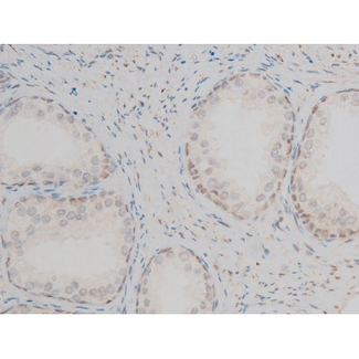 GATA1 Antibody - 1:200 staining human prostate tissue by IHC-P. The tissue was formaldehyde fixed and a heat mediated antigen retrieval step in citrate buffer was performed. The tissue was then blocked and incubated with the antibody for 1.5 hours at 22°C. An HRP conjugated goat anti-rabbit antibody was used as the secondary.
