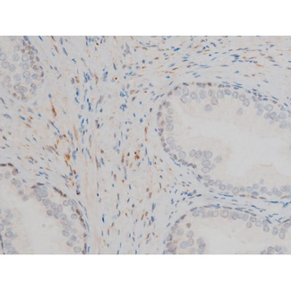 GATA1 Antibody - 1:200 staining human prostate tissue by IHC-P. The tissue was formaldehyde fixed and a heat mediated antigen retrieval step in citrate buffer was performed. The tissue was then blocked and incubated with the antibody for 1.5 hours at 22°C. An HRP conjugated goat anti-rabbit antibody was used as the secondary.