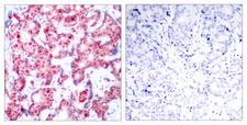 GATA1 Antibody - P-Peptide - + Immunohistochemical analysis of paraffin-embedded human breast carcinoma tissue, using GATA-1 (phospho-Ser142) antibody.