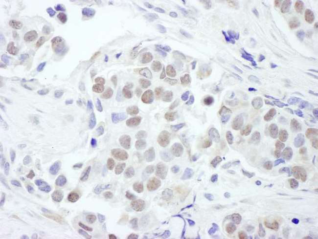 GATA3 Antibody - Detection of Human GATA3 by Immunohistochemistry. Sample: FFPE section of human breast carcinoma. Antibody: Affinity purified rabbit anti-GATA3 used at a dilution of 1:1000 (1 ug/ml). Detection: DAB.