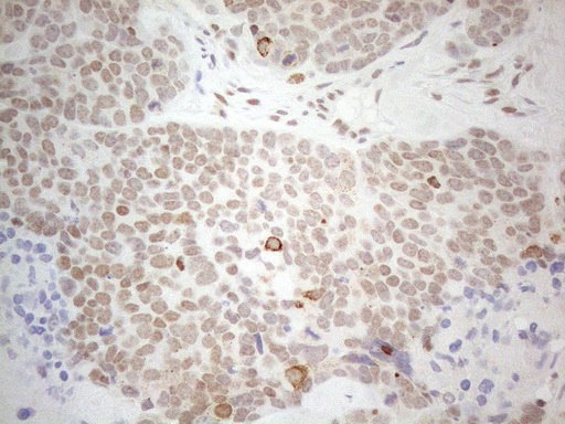 GATA3 Antibody - Immunohistochemical staining of paraffin-embedded Human prostate tissue using anti-GATA3 mouse monoclonal antibody. (Heat-induced epitope retrieval by 1mM EDTA in 10mM Tris buffer. (pH8.5) at 120°C for 3 min. (1:150)