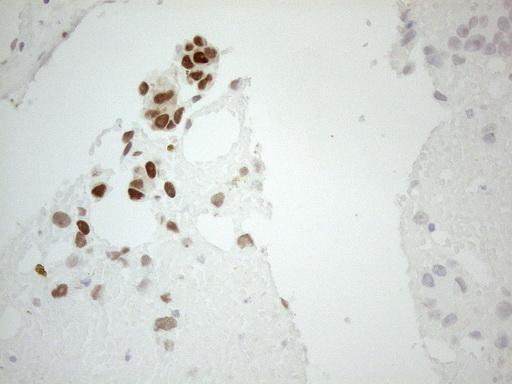 GATA3 Antibody - Immunohistochemical staining of paraffin-embedded Adenocarcinoma of Human breast tissue using anti-GATA3 mouse monoclonal antibody. (Heat-induced epitope retrieval by 1mM EDTA in 10mM Tris buffer. (pH8.5) at 120°C for 3 min. (1:150)