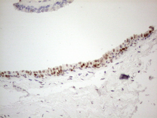 GATA3 Antibody - Immunohistochemical staining of paraffin-embedded Adenocarcinoma of Human colon tissue using anti-GATA3 mouse monoclonal antibody. (Heat-induced epitope retrieval by 1mM EDTA in 10mM Tris buffer. (pH8.5) at 120°C for 3 min. (1:150)