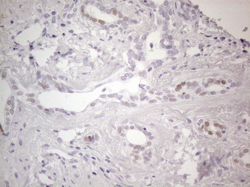 GATA3 Antibody - Immunohistochemical staining of paraffin-embedded Human prostate tissue within the normal limits using anti-GATA3 mouse monoclonal antibody. (Heat-induced epitope retrieval by 1mM EDTA in 10mM Tris buffer. (pH8.5) at 120°C for 3 min. (1:200)