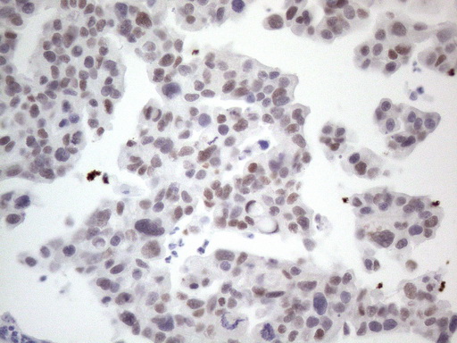 GATA3 Antibody - Immunohistochemical staining of paraffin-embedded Carcinoma of Human bladder tissue using anti-GATA3 mouse monoclonal antibody. (Heat-induced epitope retrieval by 1mM EDTA in 10mM Tris buffer. (pH8.5) at 120°C for 3 min. (1:200)