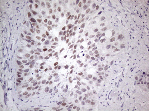 GATA3 Antibody - Immunohistochemical staining of paraffin-embedded Carcinoma of Human kidney tissue using anti-GATA3 mouse monoclonal antibody. (Heat-induced epitope retrieval by 1mM EDTA in 10mM Tris buffer. (pH8.5) at 120°C for 3 min. (1:200)