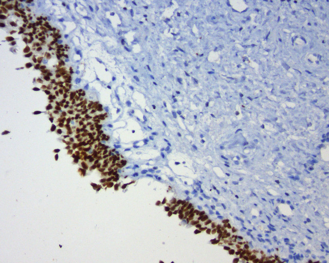 GATA3 Antibody - Immunohistochemical staining of paraffin-embedded human bladder cancer using anti-GATA3 clone UMAB210 at 1:200 dilution of 1 mg/mL and detection with Polink2 Broad HRP DAB.requires heat-induced epitope retrieval with ACCEL. (pH8.7) biocare pressure cooker at 110C for 3 minutes. The image shows nuclear staining in tumor cells.