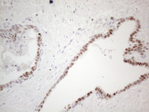 GATA3 Antibody - Immunohistochemical staining of paraffin-embedded carcinoma of human prostate tissue using anti-GATA3 mouse monoclonal antibody. HIER pretreatment was done with 1mM EDTA in 10mM Tris buffer. (pH8.0) at 120°C for 2.5 minutes.was diluted 1:50 and detection was done with HRP secondary and DAB chromogen. Stong nuclear stain was seen in the tumor cells.