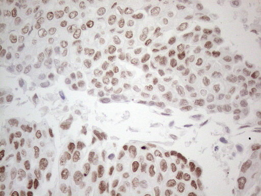 GATA3 Antibody - Immunohistochemical staining of paraffin-embedded human urothelial carcinoma using anti-GATA3 mouse monoclonal antibody. HIER pretreatment was done with 1mM EDTA in 10mM Tris buffer. (pH8.0) at 120°C for 2.5 minutes.was diluted 1:50 and detection was done with HRP secondary and DAB chromogen. Strong nuclear stain is seen in the tumor cells.