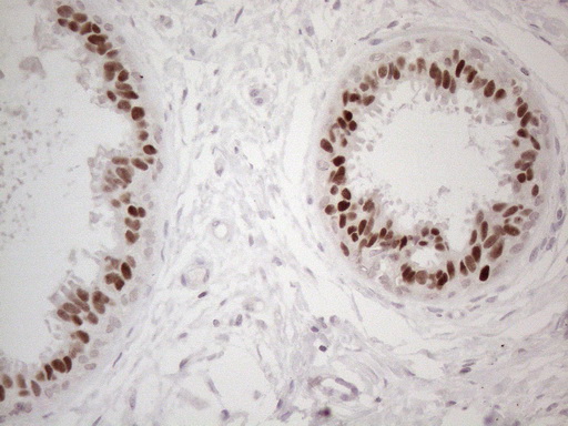 GATA3 Antibody - Immunohistochemical staining of paraffin-embedded at margins of adenocarcinoma of human breast tissue using anti-GATA3 mouse monoclonal antibody. HIER pretreatment was done with 1mM EDTA in 10mM Tris buffer. (pH8.0) at 120°C for 2.5 minutes.was diluted 1:50 and detection was done with HRP secondary and DAB chromogen. Strong nuclear stain is seen in the epithelial cells.