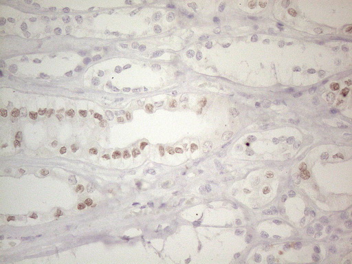 GATA3 Antibody - Immunohistochemical staining of paraffin-embedded human kidney tissue within the normal limits using anti-GATA3 mouse monoclonal antibody. HIER pretreatment was done with 1mM EDTA in 10mM Tris buffer. (pH8.0) at 120°C for 2.5 minutes.was diluted 1:50, detection was done with HRP secondary and DAB chromogen. Weak nuclear stain is seen in the tubule epithelial cells of the kidney.
