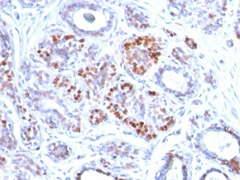GATA3 Antibody - IHC testing of FFPE human breast carcinoma with GATA3 antibody. Required HIER: boil tissue sections in 10mM citrate buffer, pH 6, for 10-20 min and allow to cool prior to testing.
