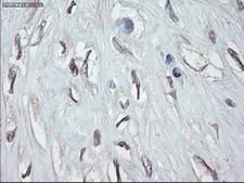 GATA4 Antibody - IHC of paraffin-embedded Human pancreatic carcinoma tissue using anti-GATA4 mouse monoclonal antibody.