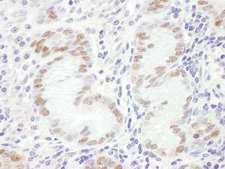 GATA4 Antibody - Detection of Human GATA4 by Immunohistochemistry. Sample: FFPE section of human stomach linitis plastica. Antibody: Affinity purified rabbit anti-GATA4 used at a dilution of 1:1000 (1 ug/ml). Detection: DAB.