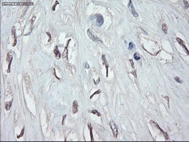GATA4 Antibody - IHC of paraffin-embedded Human pancreatic carcinoma tissue using anti-GATA4 mouse monoclonal antibody.