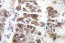 GATA4 Antibody - IHC of GATA4 (P101) pAb in paraffin-embedded human lung carcinoma tissue.