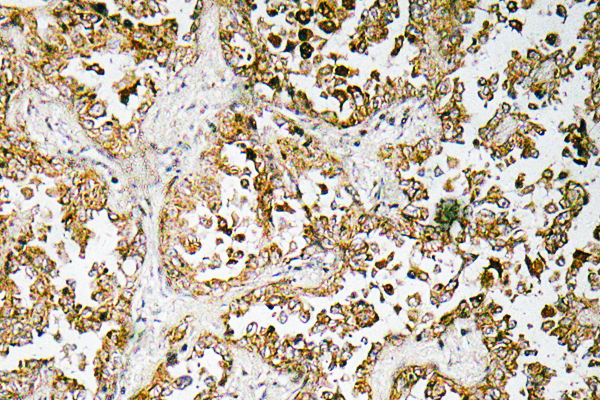 GATA5 Antibody - Immunohistochemistry analysis of GATA-5 antibody in paraffin-embedded human lung carcinoma tissue.