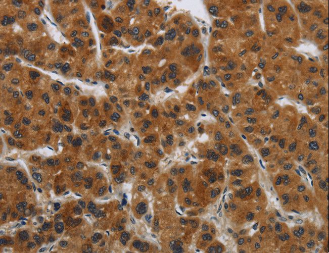 GATA5 Antibody - Immunohistochemistry of paraffin-embedded Human liver cancer using GATA5 Polyclonal Antibody at dilution of 1:50.