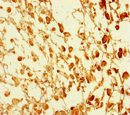 GATA6 Antibody - Immunohistochemistry of paraffin-embedded human melanoma cancer at dilution of 1:100